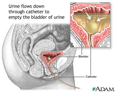 Bladder catheterization - female Bladder catheterization - female