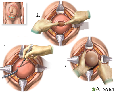 Cesarean section Cesarean section