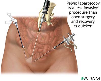 Pelvic laparoscopy Pelvic laparoscopy