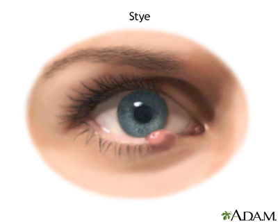 Stye Stye