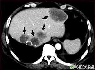 Liver metastases, CT scan Liver metastases, CT scan