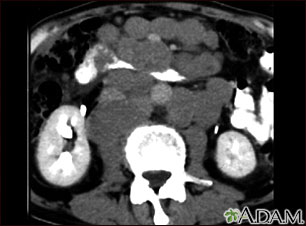 Lymphoma, malignant - CT scan Lymphoma, malignant - CT scan