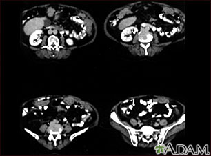 Peritoneal and ovarian cancer, CT scan Peritoneal and ovarian cancer, CT scan