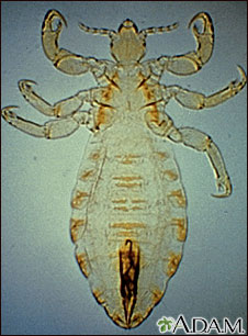 Body louse Body louse