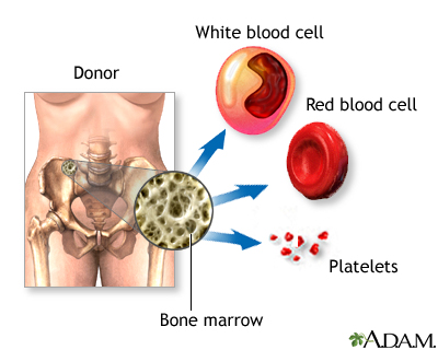 Bone-marrow transplant - series Bone-marrow transplant - series