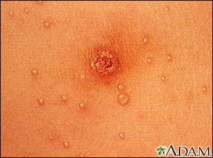 Molluscum contagiosum - close-up of the chest Molluscum contagiosum - close-up of the chest