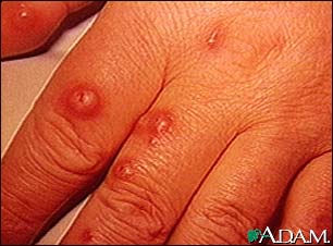 Cryptococcus - cutaneous on the hand