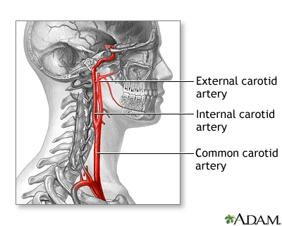 Carotid artery surgery - series Carotid artery surgery - series