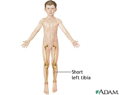 Leg lengthening - series