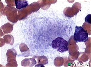 Gaucher cell - photomicrograph