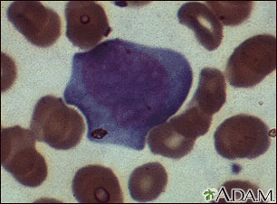 Mononucleosis - photomicrograph of cells Mononucleosis - photomicrograph of cells
