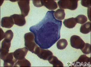 Mononucleosis - photomicrograph of cells Mononucleosis - photomicrograph of cells