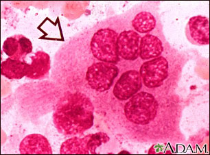 Osteoclast Osteoclast