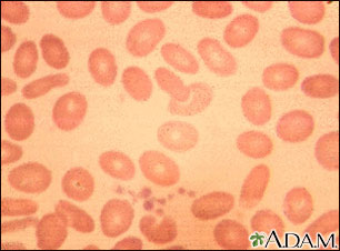 Ovalocytosis