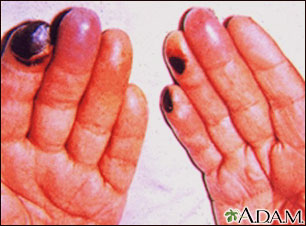Cryoglobulinemia of the fingers