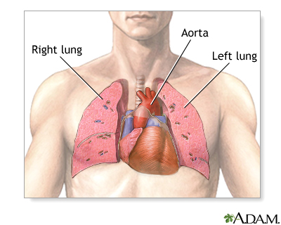Heart-lung transplant - series - Normal anatomy Heart-lung transplant - series - Normal anatomy