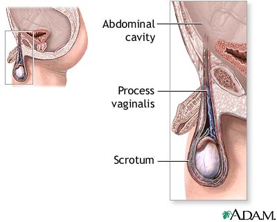 Hydrocele repair - series Hydrocele repair - series