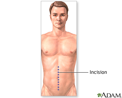 Incision Incision