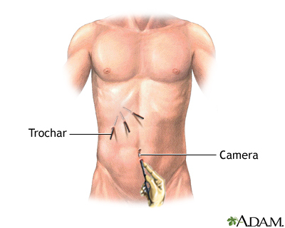 Laparoscopic surgery - series - Incision