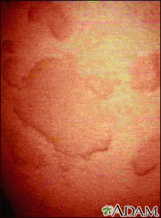 Hives (urticaria) - close-up Hives (urticaria) - close-up