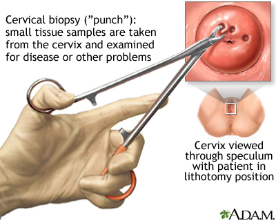 Cervical biopsy Cervical biopsy