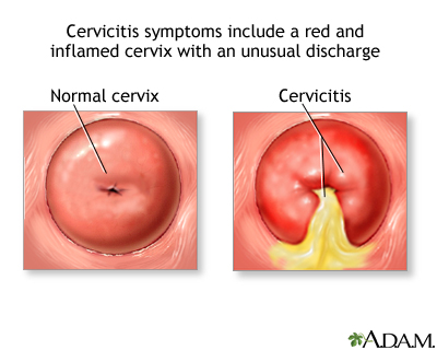 Cervicitis Cervicitis