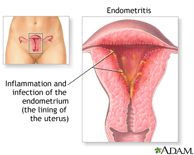 Endometritis Endometritis