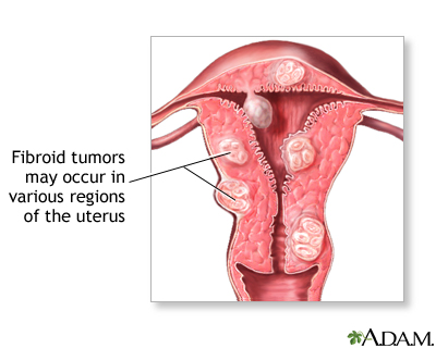 Fibroid tumors Fibroid tumors