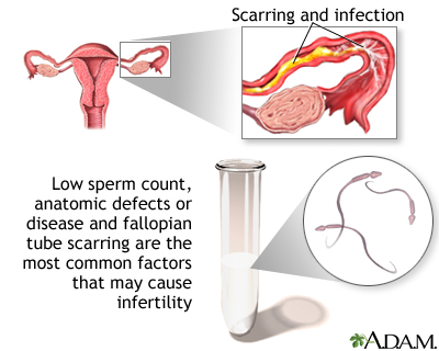 Primary infertility Primary infertility