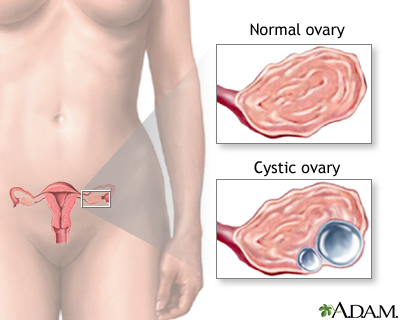 Ovarian cysts Ovarian cysts