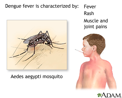 Dengue fever Dengue fever
