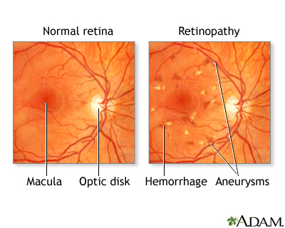 Diabetic retinopathy Diabetic retinopathy
