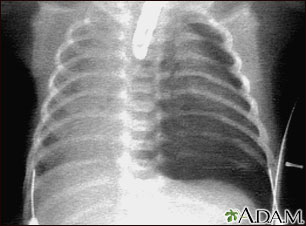 Pneumothorax - chest X-ray Pneumothorax - chest X-ray
