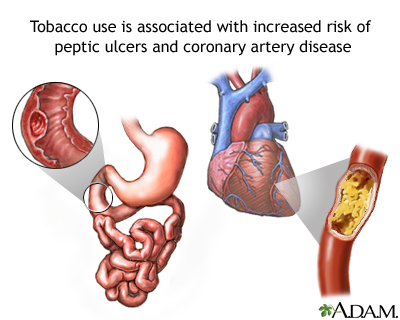 Tobacco and vascular disease Tobacco and vascular disease