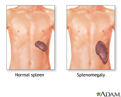 Splenomegaly Splenomegaly