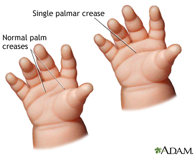 Single palmar crease Single palmar crease