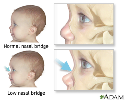 Low nasal bridge Low nasal bridge