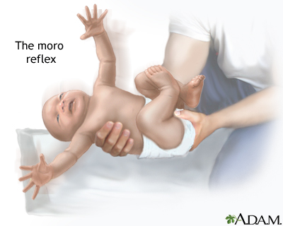 Moro reflex Moro reflex