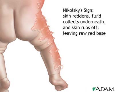 Nikolsky sign Nikolsky sign