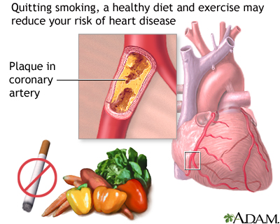 Prevention of heart disease Prevention of heart disease
