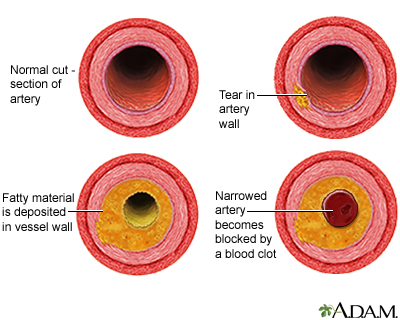 Developmental process of atherosclerosis Developmental process of atherosclerosis