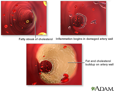 Arterial plaque build-up Arterial plaque build-up
