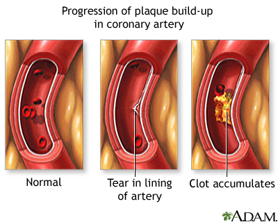 Progressive build-up of plaque in coronary artery Progressive build-up of plaque in coronary artery