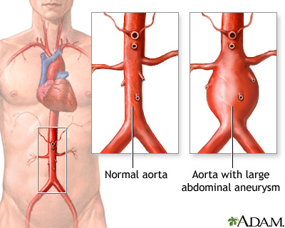 Aortic aneurysm Aortic aneurysm