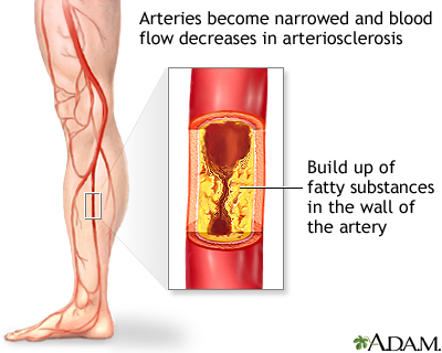 Arteriosclerosis of the extremities Arteriosclerosis of the extremities