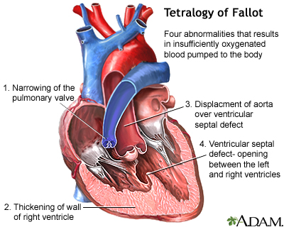 Tetralogy of Fallot Tetralogy of Fallot
