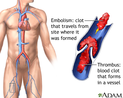 Thrombus Thrombus