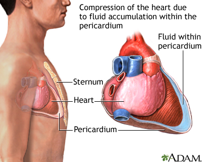 Cardiac tamponade Cardiac tamponade