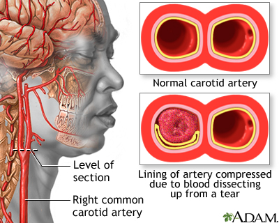 Carotid dissection Carotid dissection
