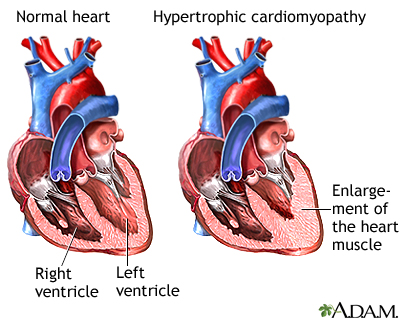 Hypertrophic cardiomyopathy Hypertrophic cardiomyopathy